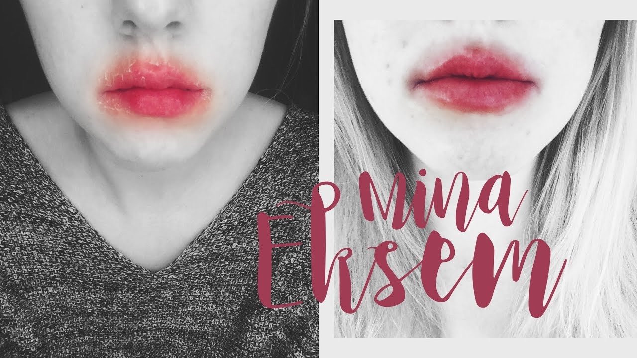 Storytime: Eksem | Tips på hur du blir av med dem