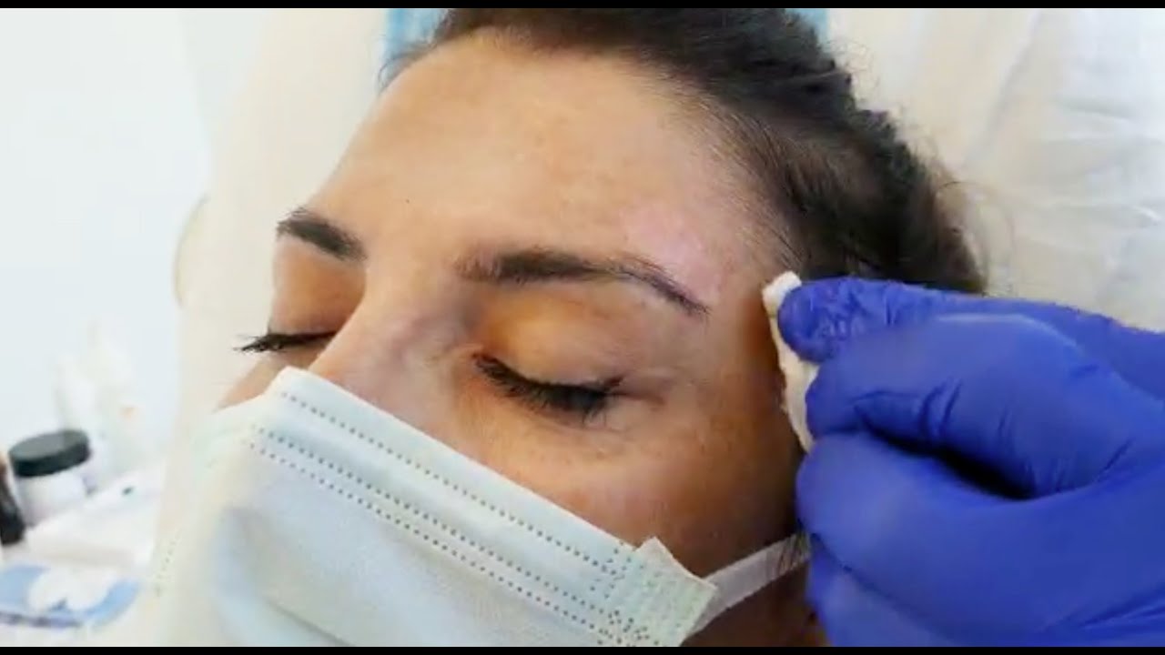 Plazma-Plexring ile Güneş Lekesi Tedavisi