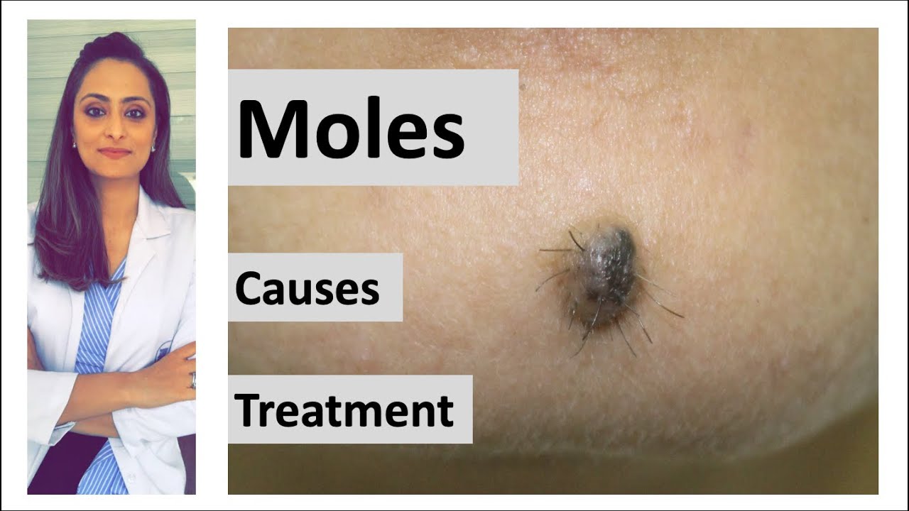 How to remove a mole | Mole: causes  & removal | home remedy | Dermatologist | Dr. Aanchal Panth