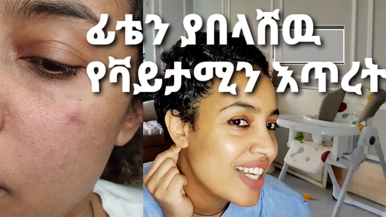 ማድያትን ጨምሮ ፊታችንን እንዲበላሽ የሚያደርገዉ የቫይታሚን D እጥረት!! ትምህርት ይሆናችሁዋል