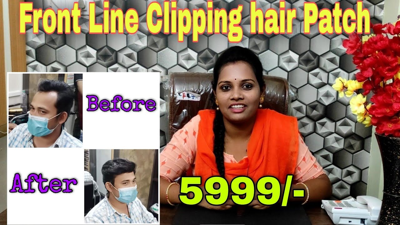 Front line hair patch with clipping 5999/- Hyderabad and Vijayawada