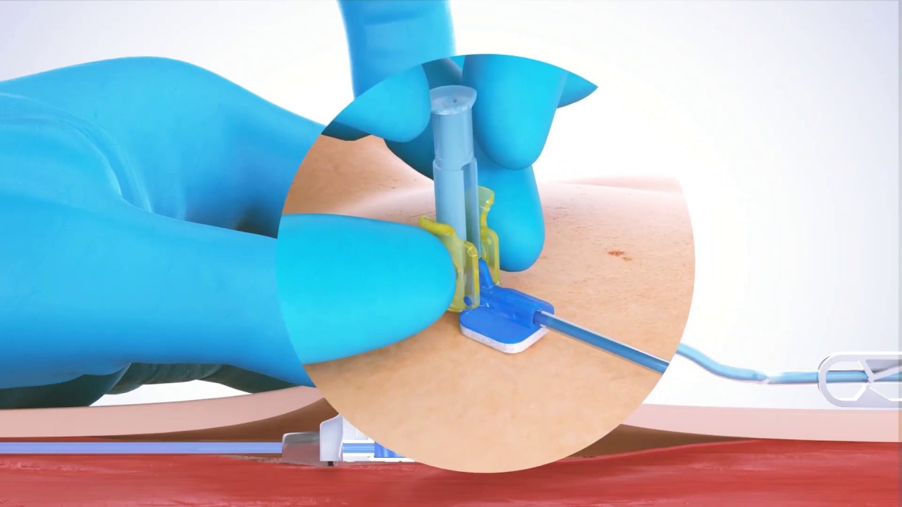 PPS Safety Huber Needle - One-handed safety needle activation