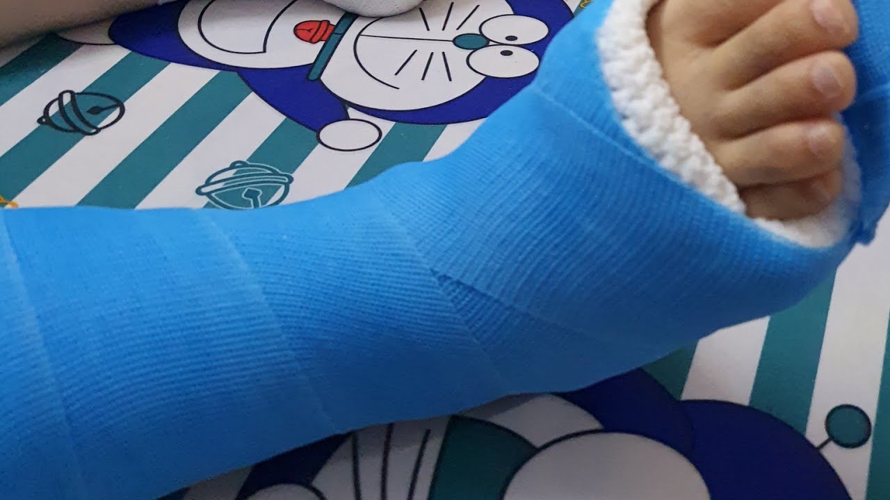 Bó bột Mica tại nhà