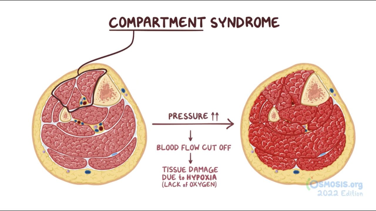 Compartment Syndrome Clinical Pitfalls