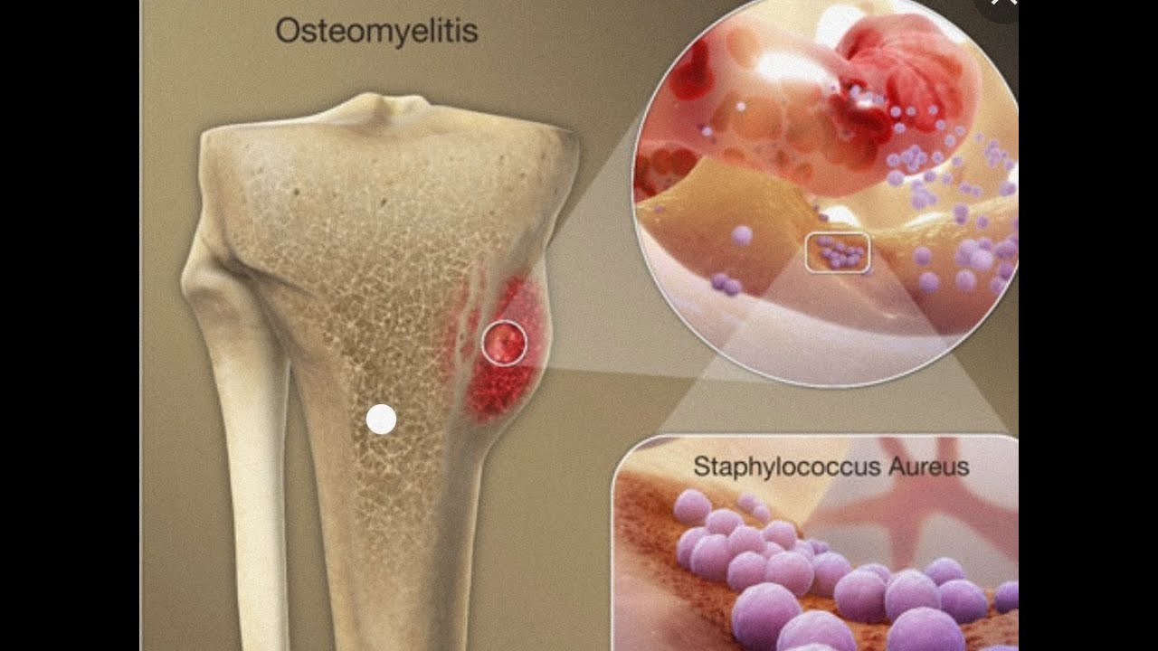osteomyltis_bone infection
