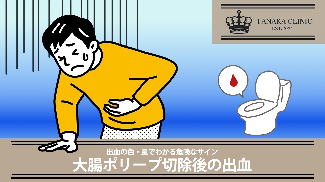 25　大腸ポリープ切除後の出血｜【胃腸と内視鏡の専門チャンネル】たなか内科クリニック