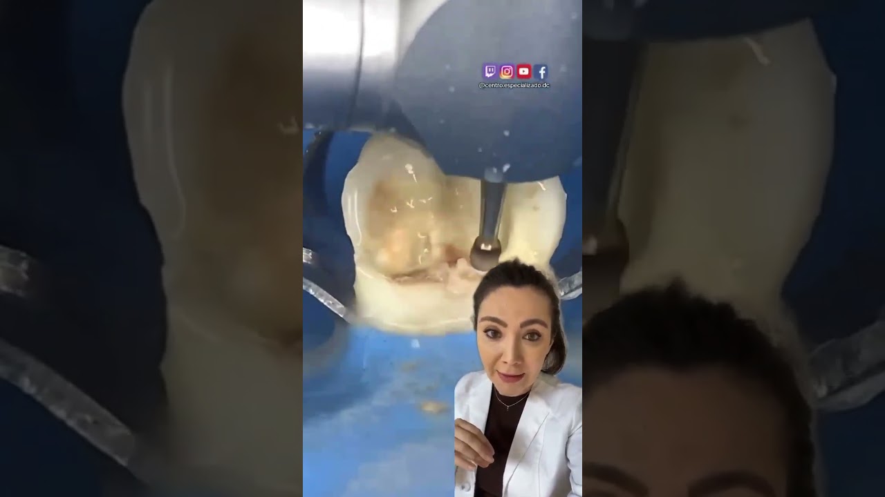 How Does Root Canal Treatment Work?!