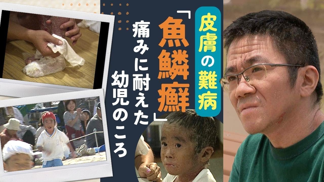 「痛いよー！」風呂に入るだけで苦しんだ６歳のころ　「魚鱗癬」とともに生きる２８歳の青年