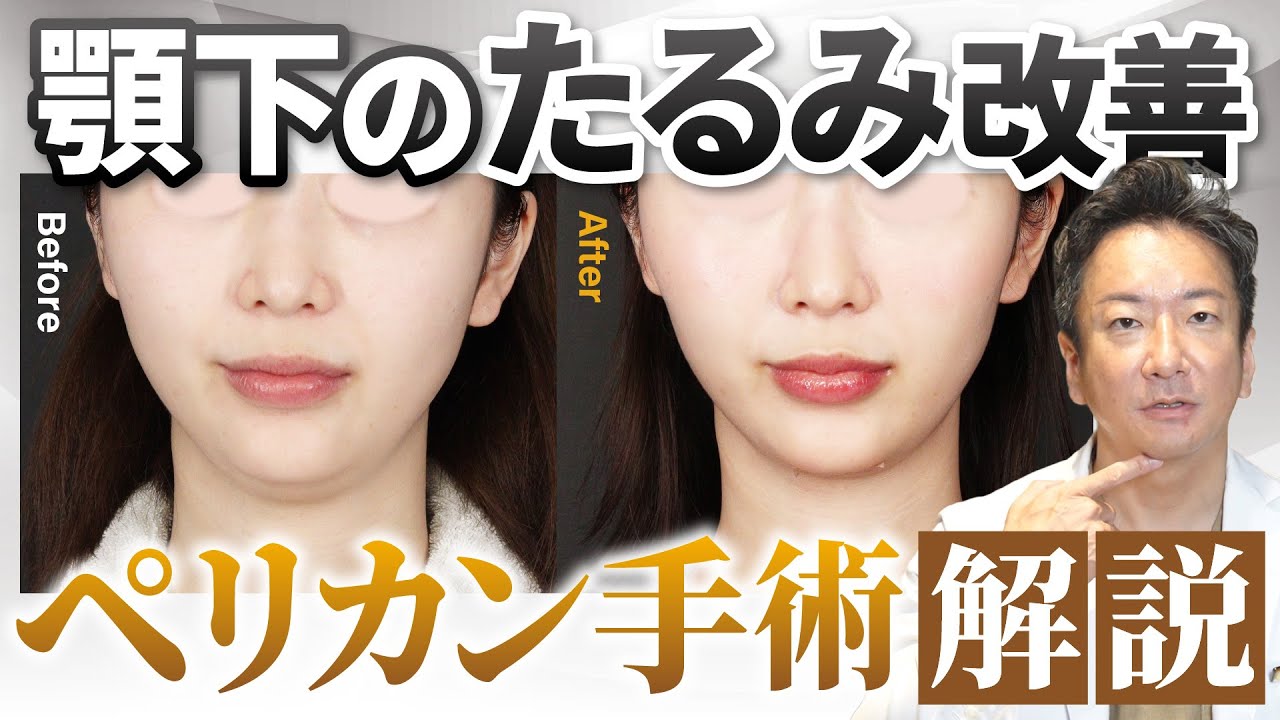 【若返り】ペリカン手術(顎下筋肉縛り)徹底解説！ダウンタイムは？【顎下のたるみ改善】