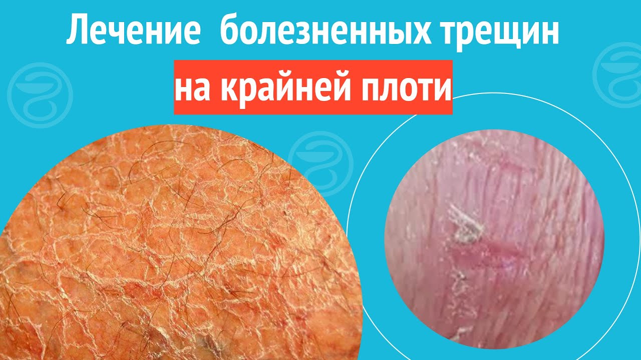 💊 Лечение  болезненных трещин на крайней плоти.  Клинический случай №1121