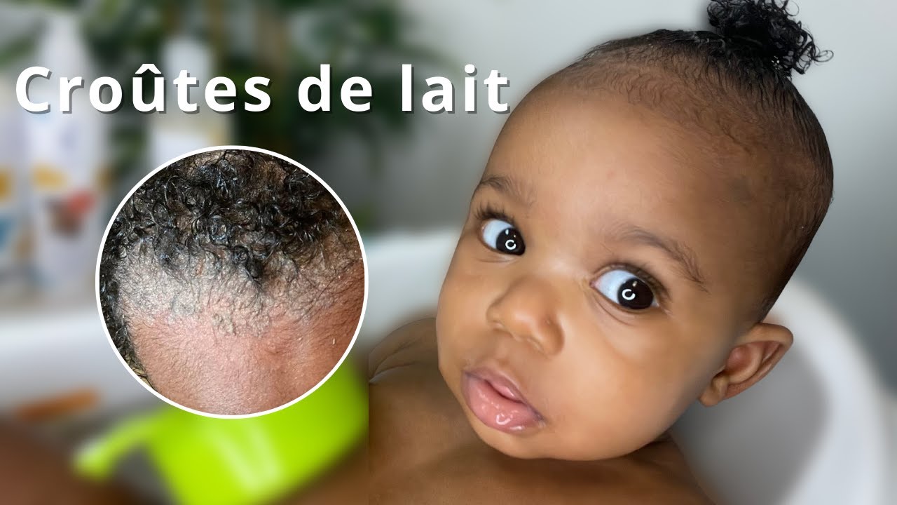 Perte de cheveux et Croutes de lait. QUOI FAIRE? | Routine capillaire cheveux crépus pour enfants |