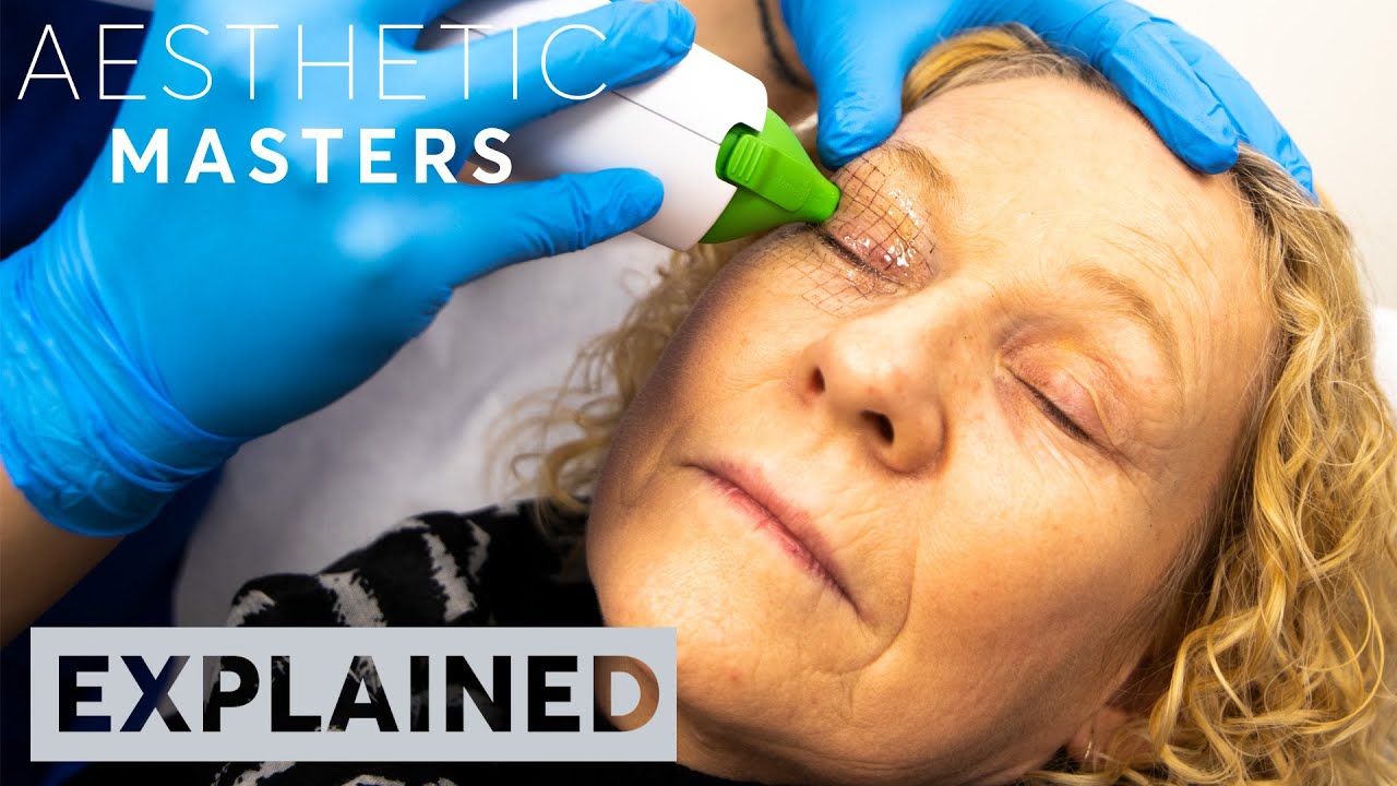 EXPLAINED: Thermage Skin Tightening Treatment | London