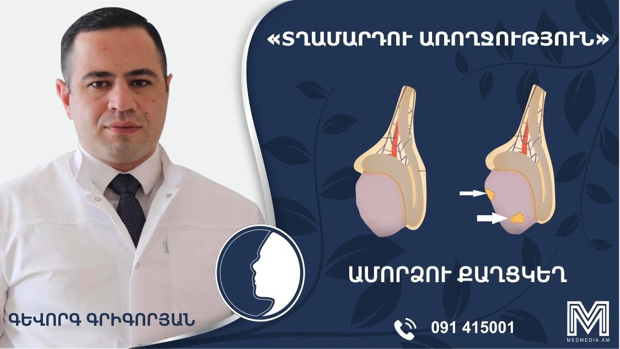 Ամորձու քաղցկեղ․ «Տղամարդու Առողջություն»