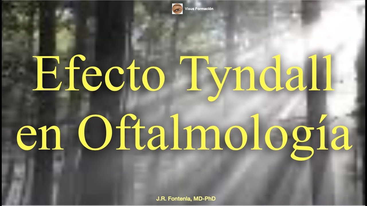 Efecto Tyndall en Oftalmolog&iacute;a. Signo de Tyndall.
