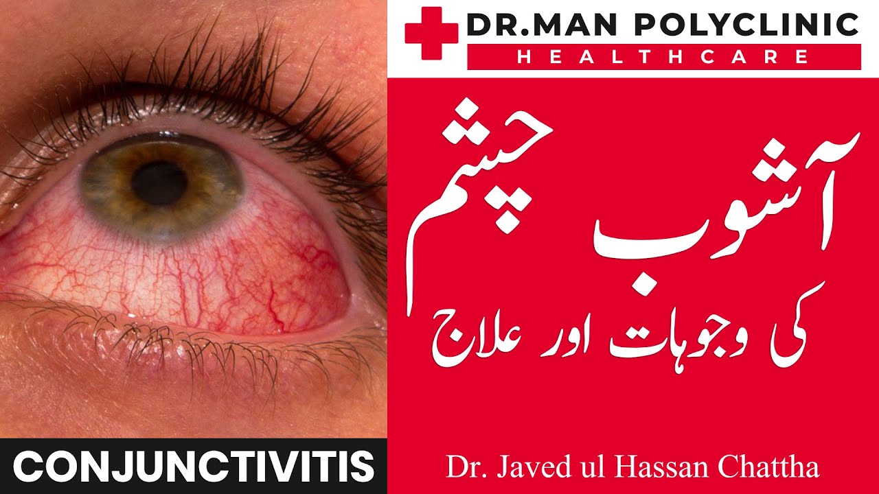 Ashob e Chashm | Conjunctivitis Epidemic | Pink Eye Infection | Ka Ilaj In Urdu | Dr. Javed Chattha