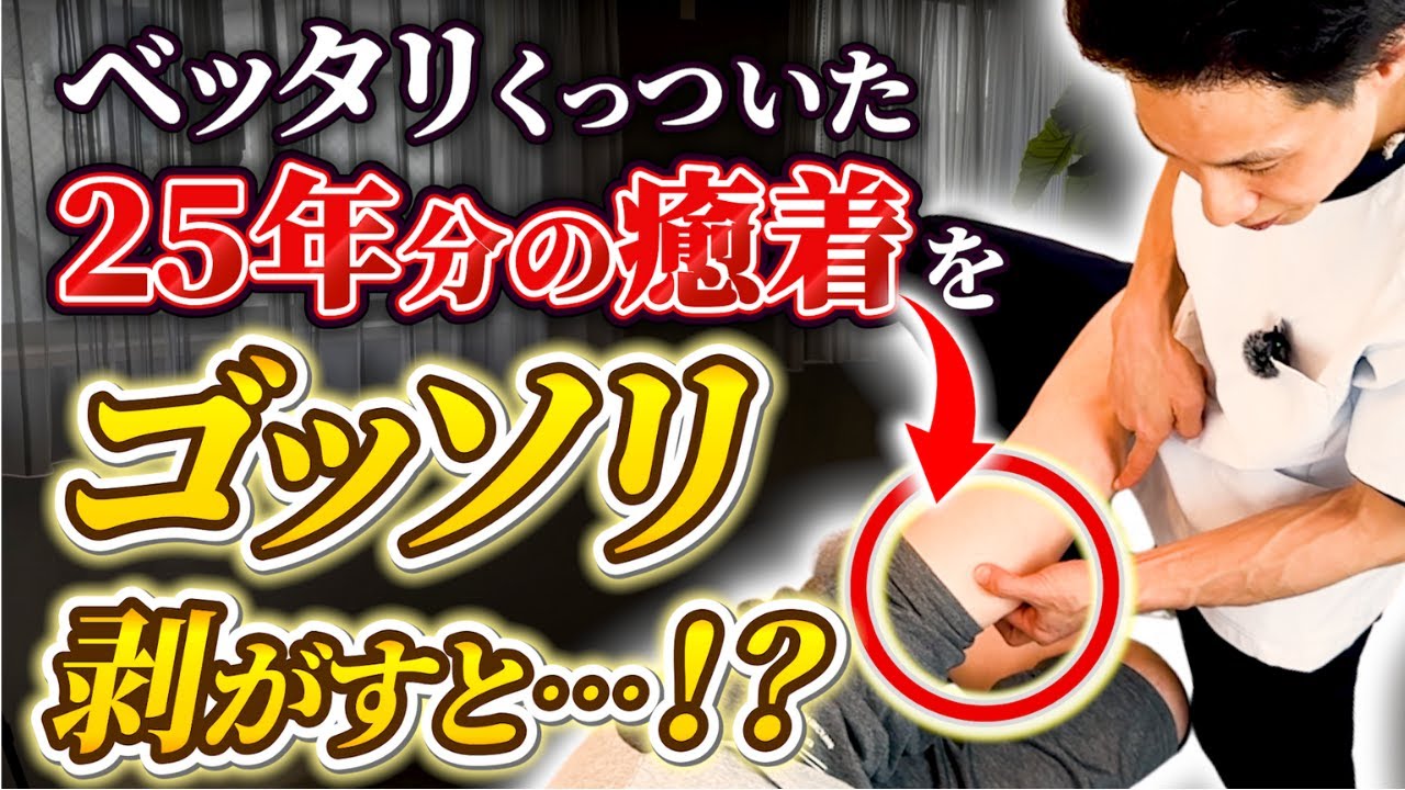 【驚愕】25年ものの癒着！？悪化し続けた股関節痛がウソのように消える動画