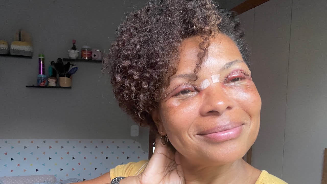 Tudo sobre Minha Cirurgia de Blefaroplastia quanto paguei? 
