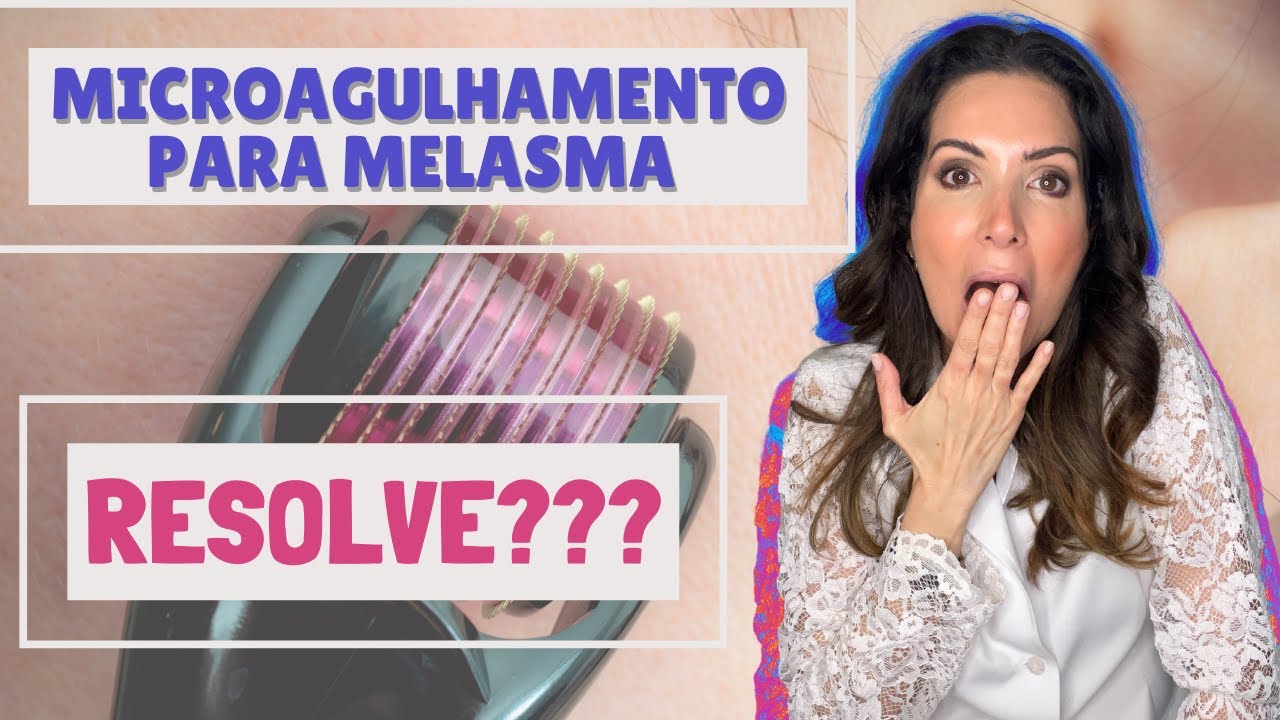 Microagulhamento clareia melasma? #microagulhamento #melasma