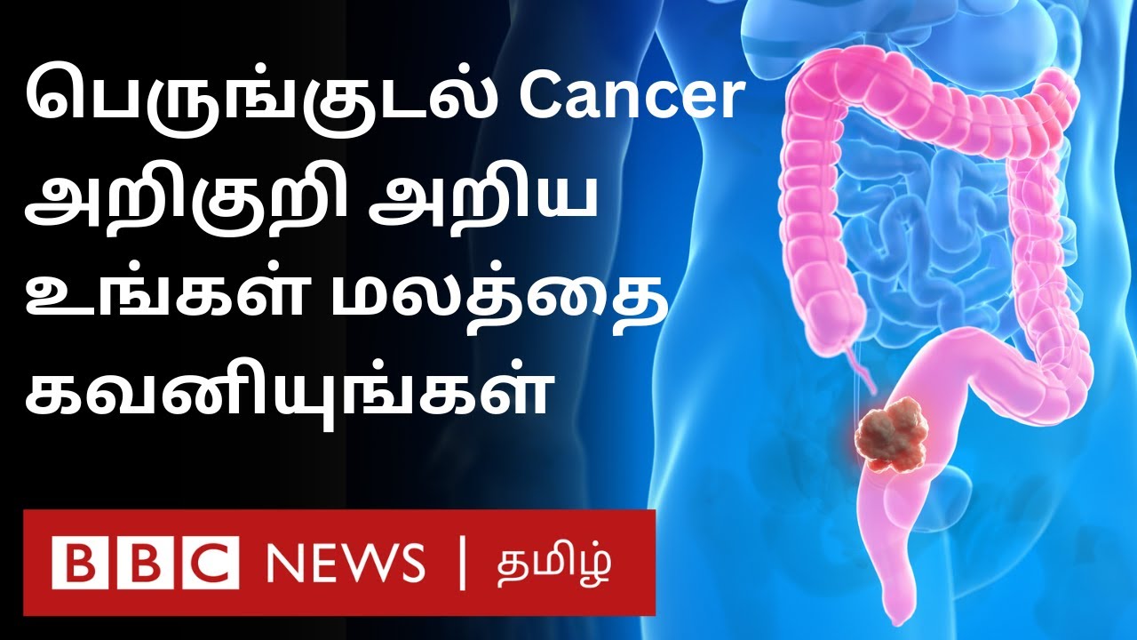 Cancer Disease: பெருங்குடல் புற்றுநோயின் முதல் அறிகுறி என்ன? எப்படி குணப்படுத்துவது?