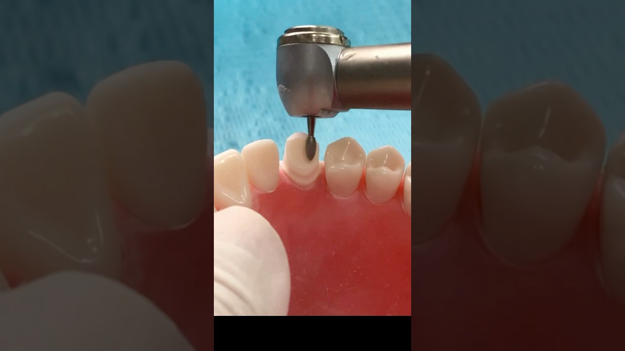 Crown preparation - Canine 