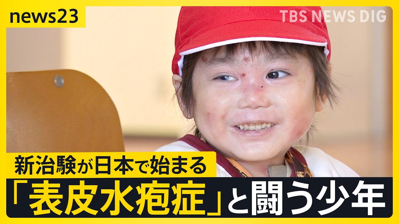 全身に水疱ができる皮膚の難病「表皮水疱症」と闘う男の子　最新の治療薬の治験が日本で始まる【news23】｜TBS NEWS DIG
