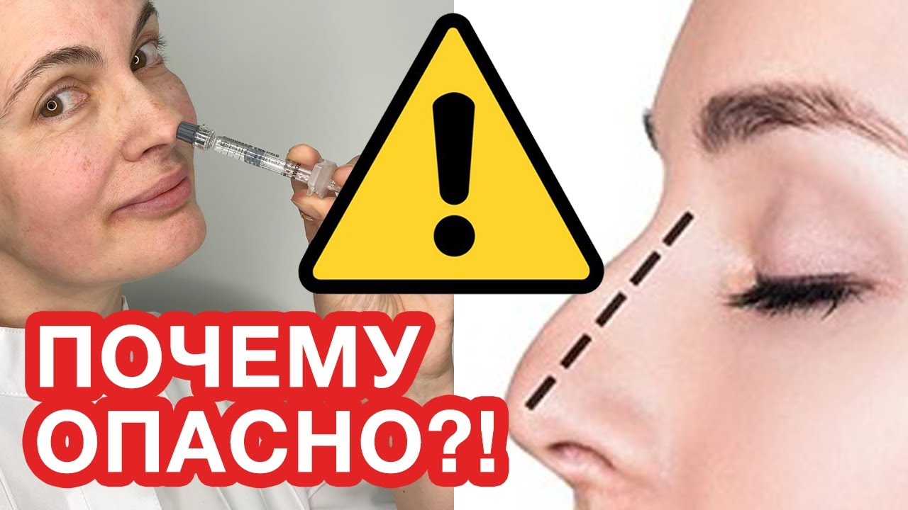 КОРРЕКЦИЯ НОСА ИЛИ КОНТУРНАЯ ПЛАСТИКА ФИЛЛЕРОМ И НИТЯМИ!  ПОЧЕМУ ОПАСНО?! - ОТВЕТ КОСМЕТОЛОГА