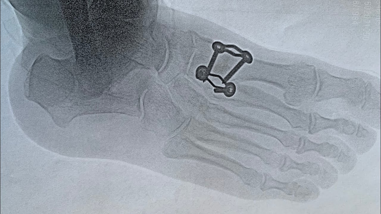 Midfoot Fusion Update: Increased Pain 1.5 years later