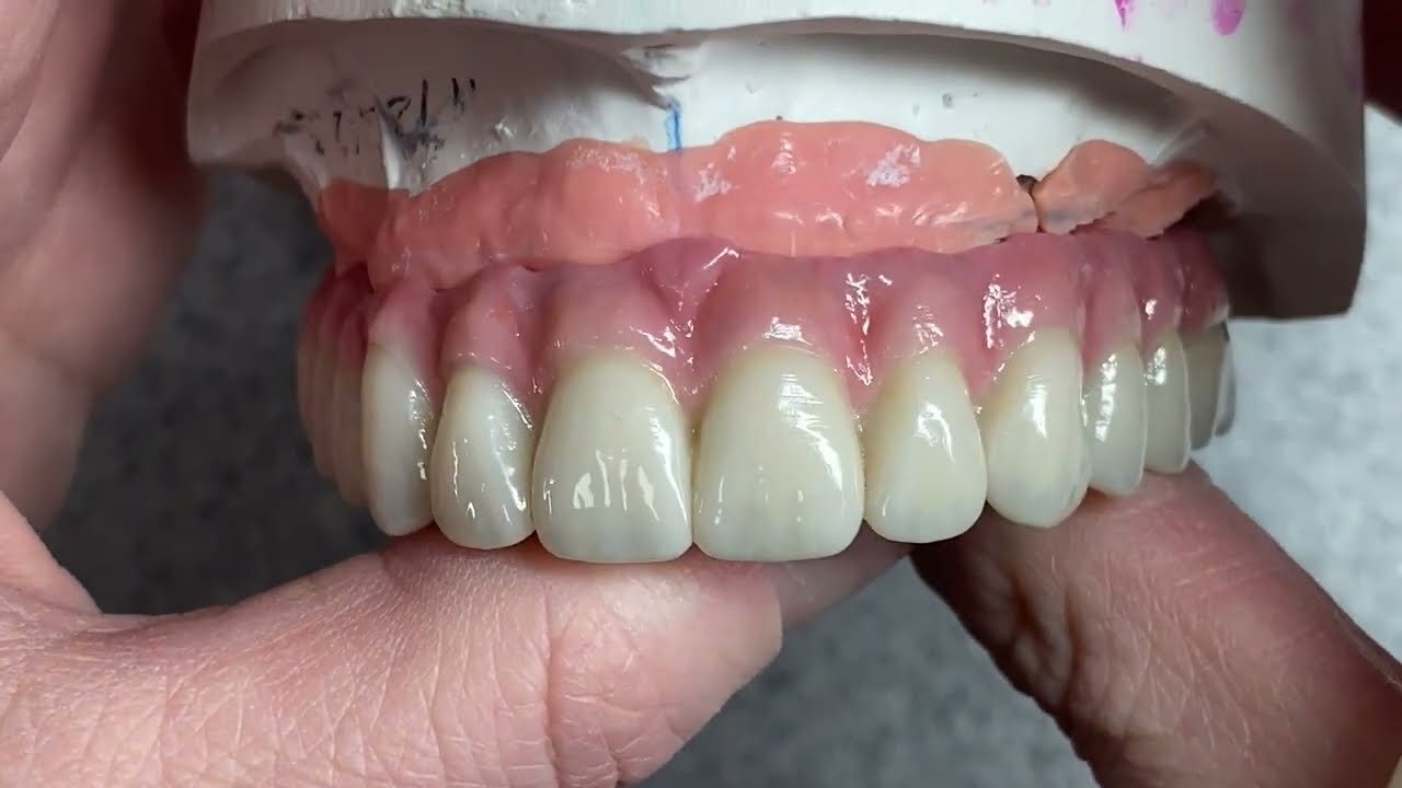 Hybrid Zirconia Case Tissue Application and Glaze