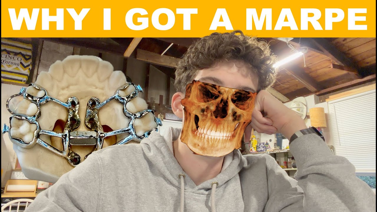 Why I got MARPE