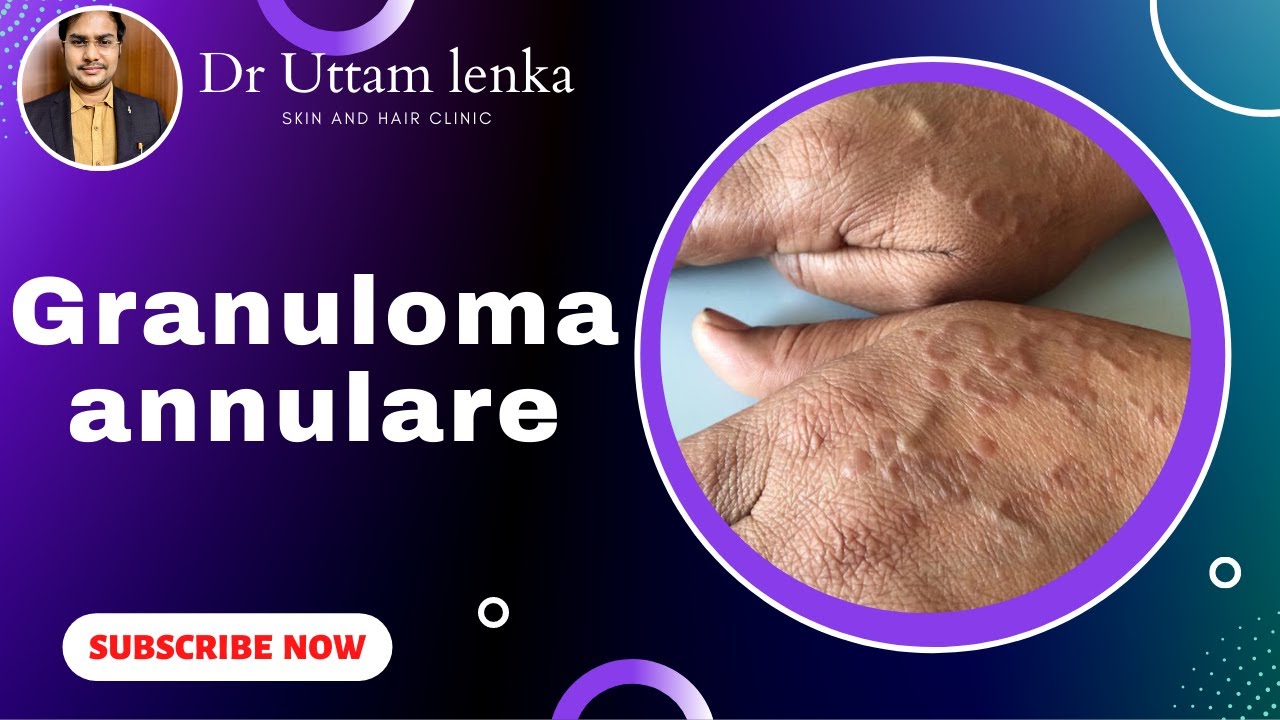 Granuloma annulare/ red circular rashes on skin/ Dr Uttam kumar Lenka skin and hair clinic
