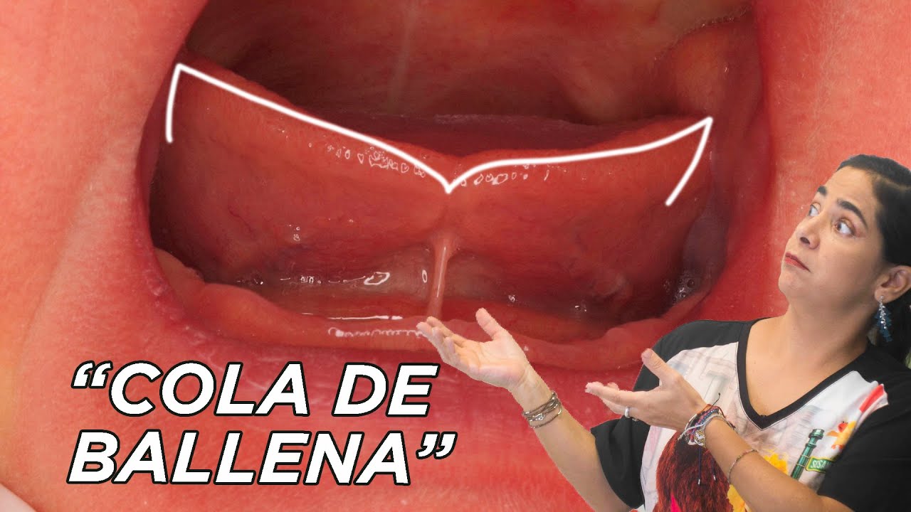 Frenillo 