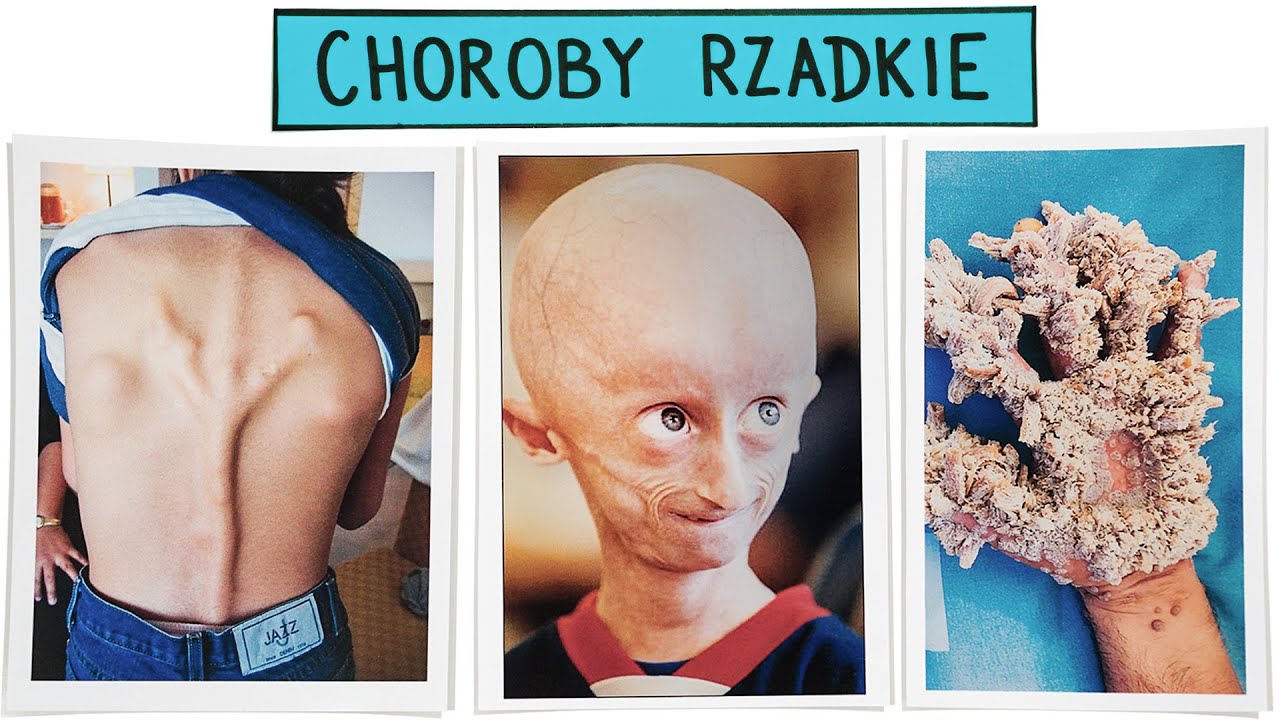 Choroby (nie)rzadkie