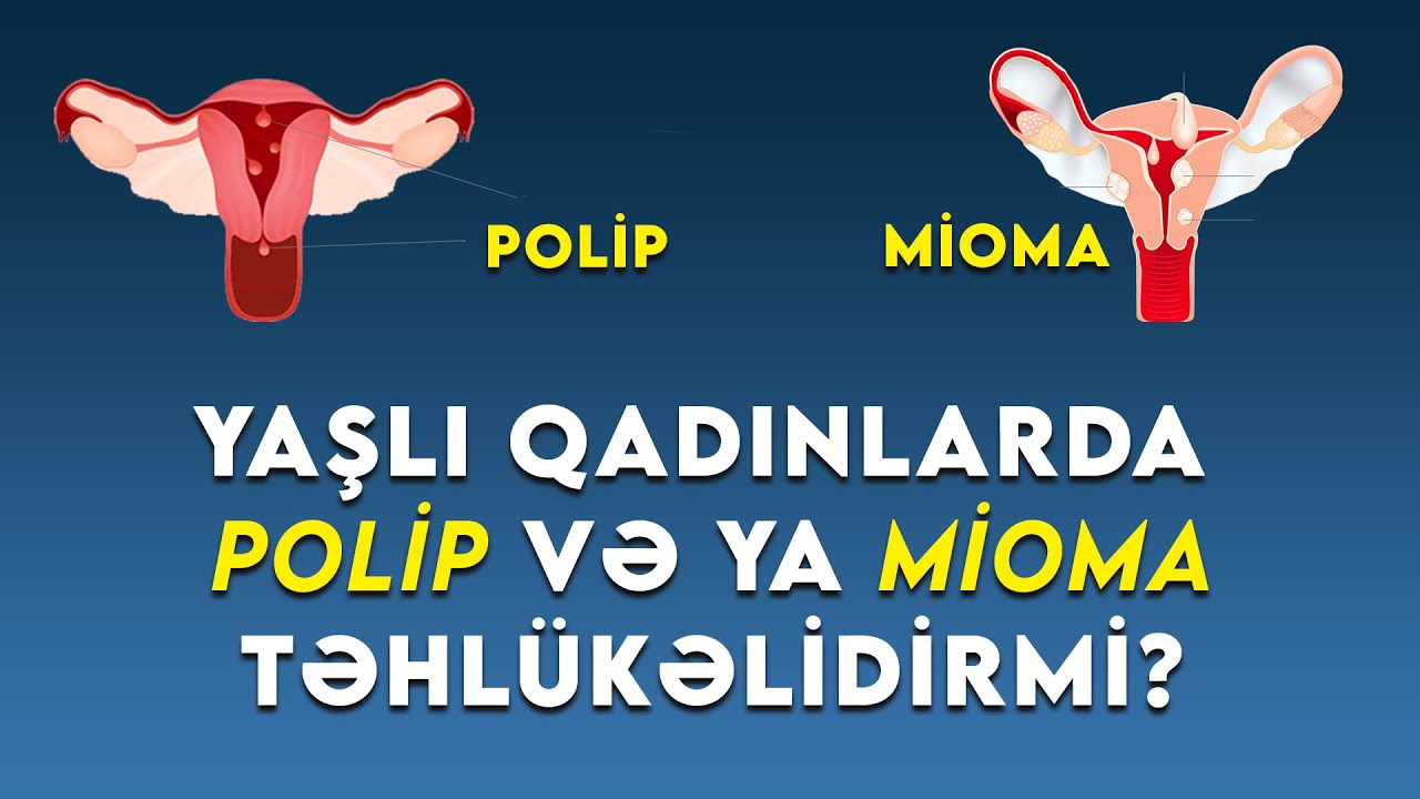 Yaşlı qadınlarda polip və ya mioma təhlükəli hal sayılırmı? ( Ginekoloq Aytən Nəcəfəliyeva )