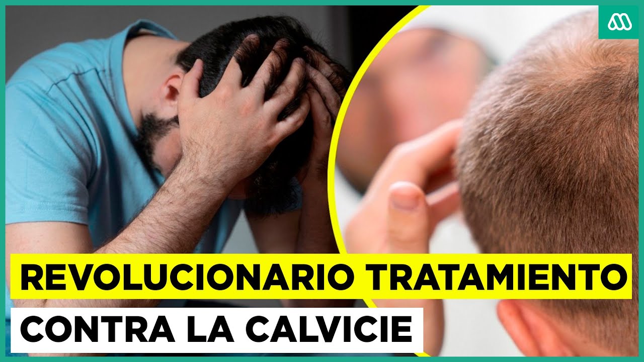 ¿El principio del fin de la calvicie? Revolucionario tratamiento para combatir la alopecia