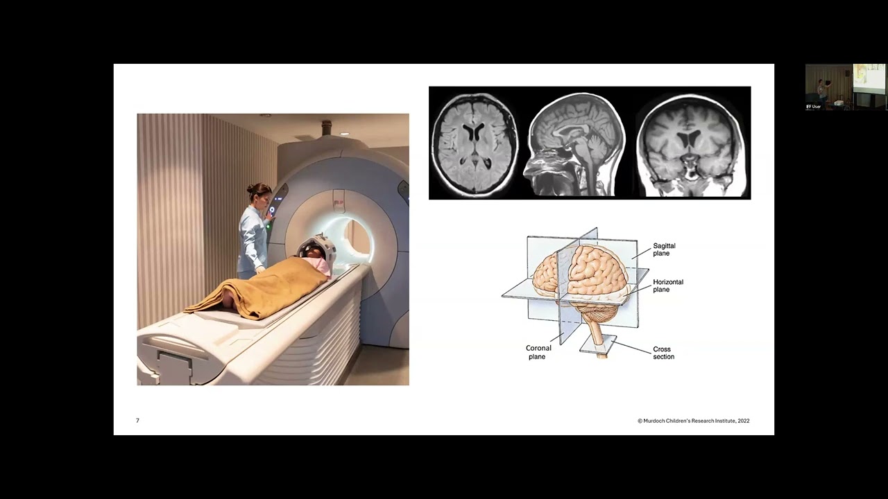 Neuroimaging in FOXP1: Prof. Tiong Yang Tan | 2025 FOXP1 Family Conference