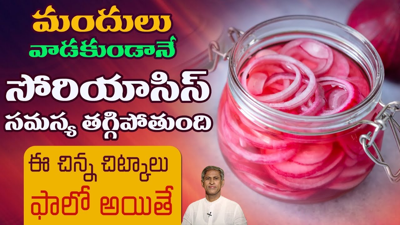 మందులు వాడకుండానే సోరియాసిస్ సమస్య తగ్గాలంటే | Autoimmune Disorders | Psoriasis | Manthena Official