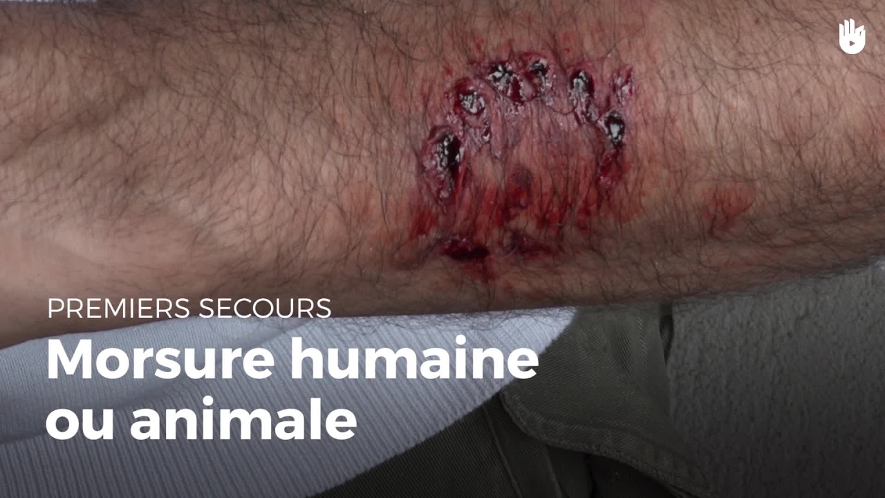 Premiers secours : Morsure animale ou humaine | Secourisme