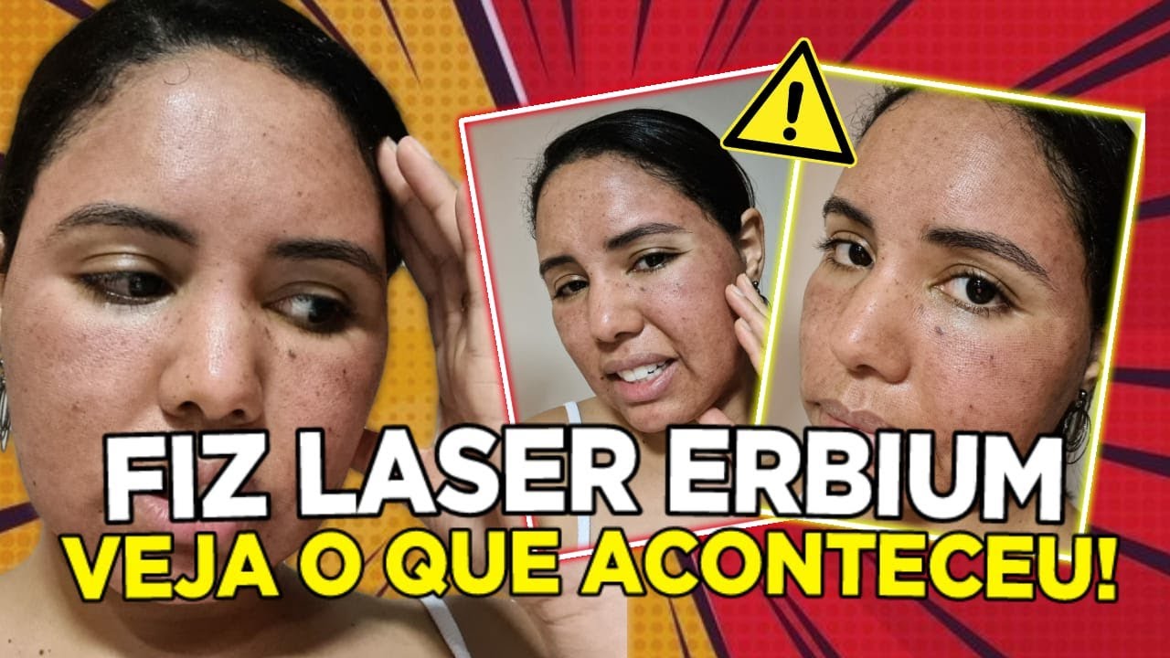Como remover cicatrizes de acne / Laser ERBIUM mais potente do que o Laser CO2