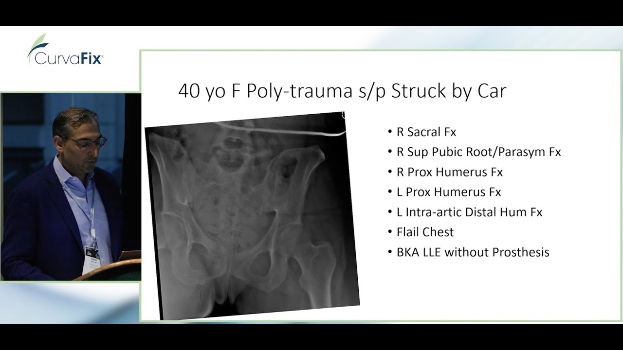High Energy Pelvic Ring Injuries Treated with CurvaFix