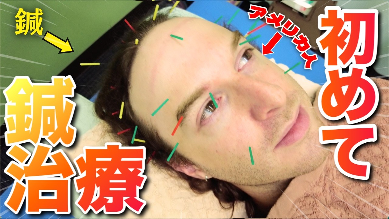 【海外の反応!?】東洋医学を全く信じていないアメリカ人旦那に、鍼治療させてみました...!?