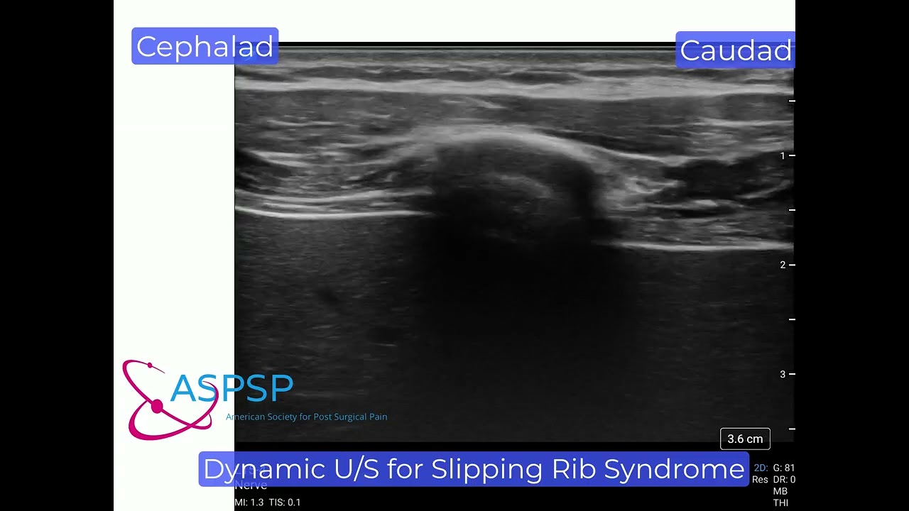Slipping Rib Syndrome- Dynamic Ultrasound