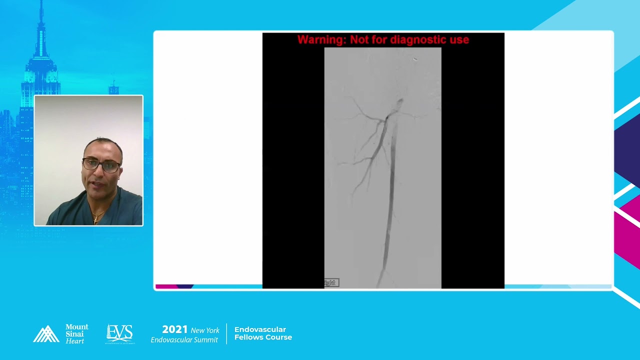 BTK Interventions  Access how to do and Principle - Rami Tadros, MD