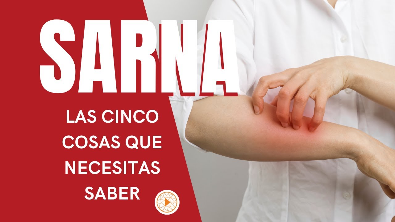 SARNA | Las 5 cosas que necesitas saber