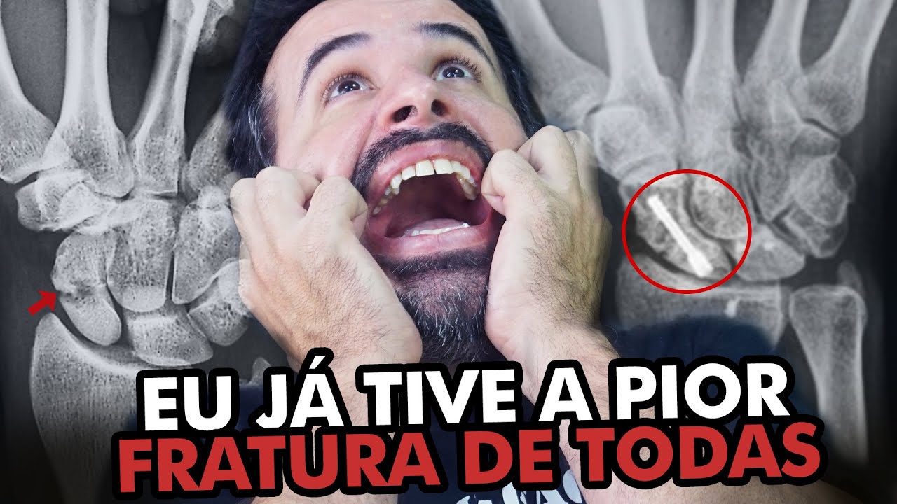 EU JÁ TIVE ESSA FRATURA E POSSO TE PROVAR QUE É A PIOR DE TODAS!