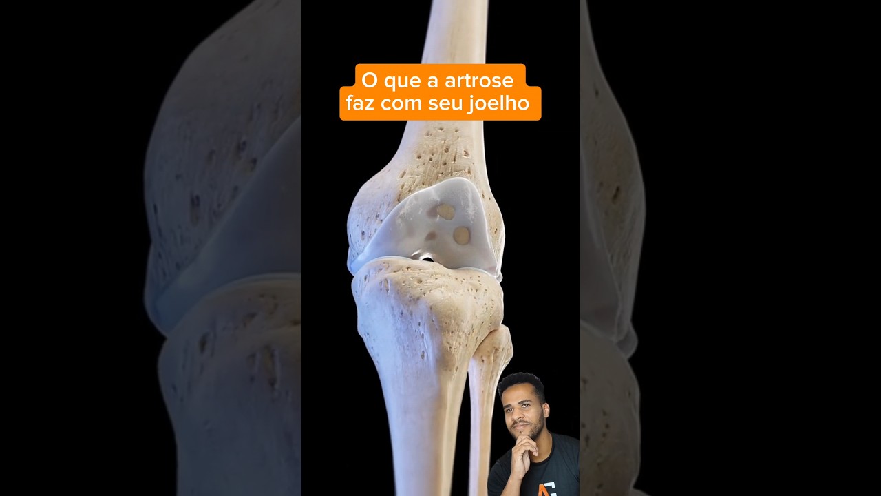 Reagindo ao desgaste da cartilagem do joelho: Dor da osteoartrose 