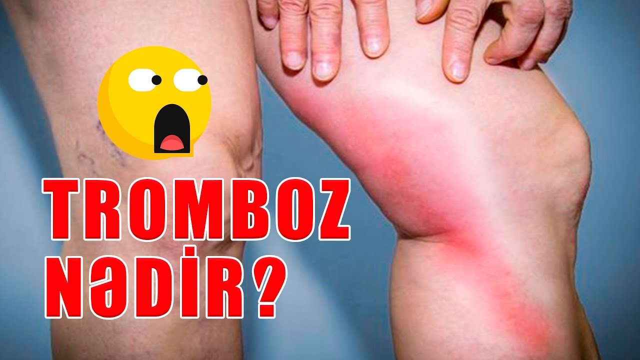 Tromboz nədir? Əlamətləri, müayinəsi və müalicəsi
