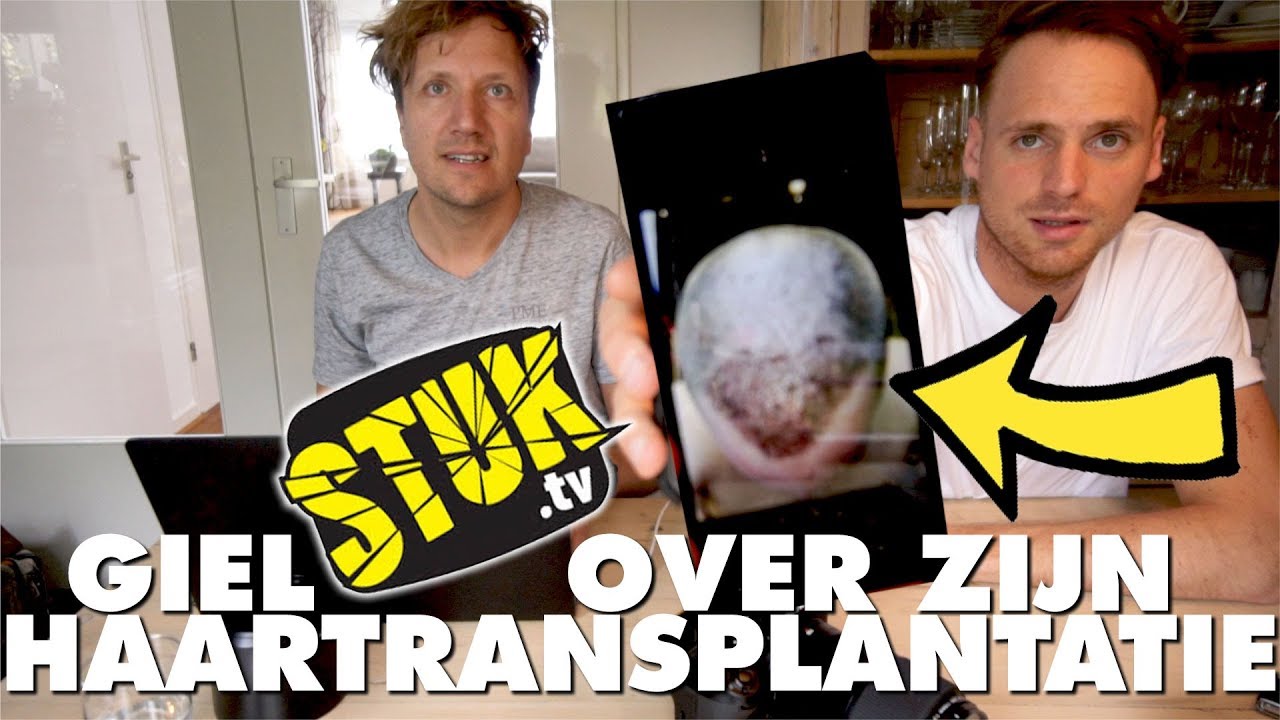STUKTV GIEL OVER HAARTRANSPLANTATIE | KLAAS KOMT KIEKEN