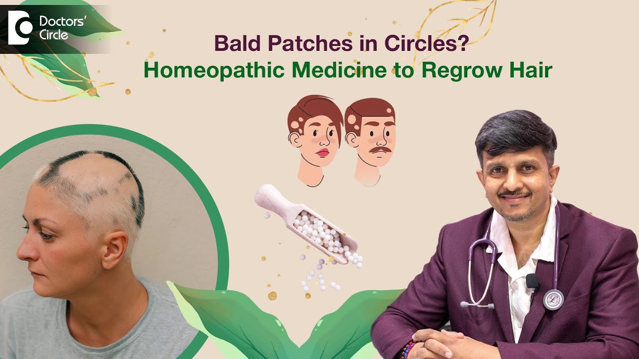 Alopecia areata natural treatment|Homeopathic Medicine for Hair Fall & Regrowth - Doctors' Circle