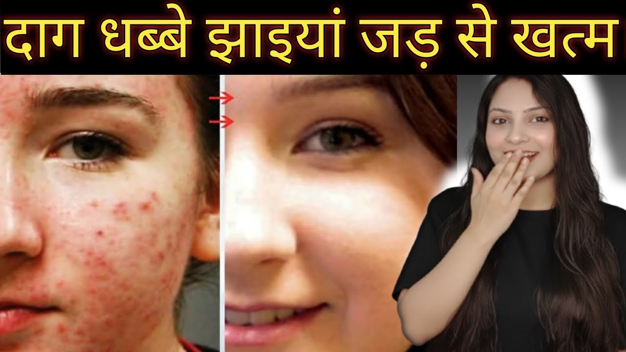 रोज रात को सोने से पहले इसे लगा लो तब पूछेंगे क्या लगाया?#pigmentation #beauty #skincareroutine