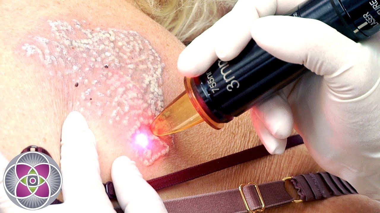 Laser Tattoo Removal Before and After Treatment